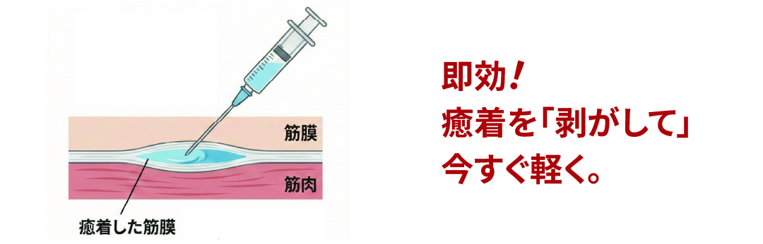 ハイドロリリース注射の図解