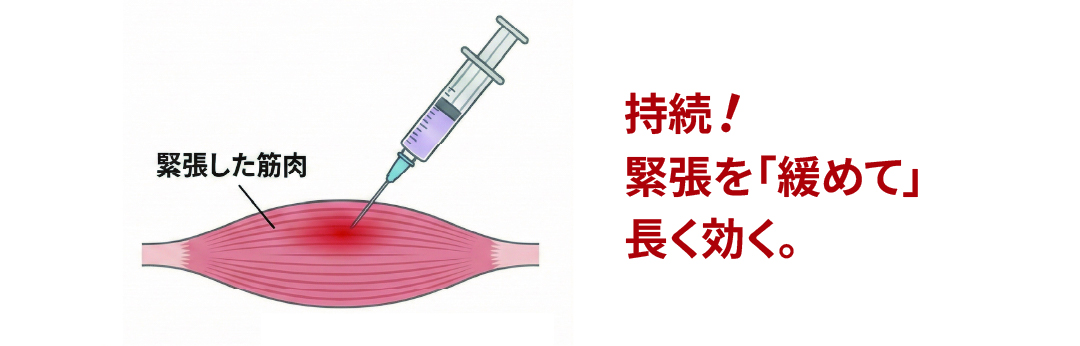 肩ボトックス注射の図解